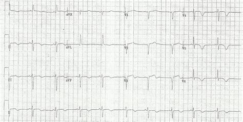 lv gram medical abbreviation|Lv gram cardiology.